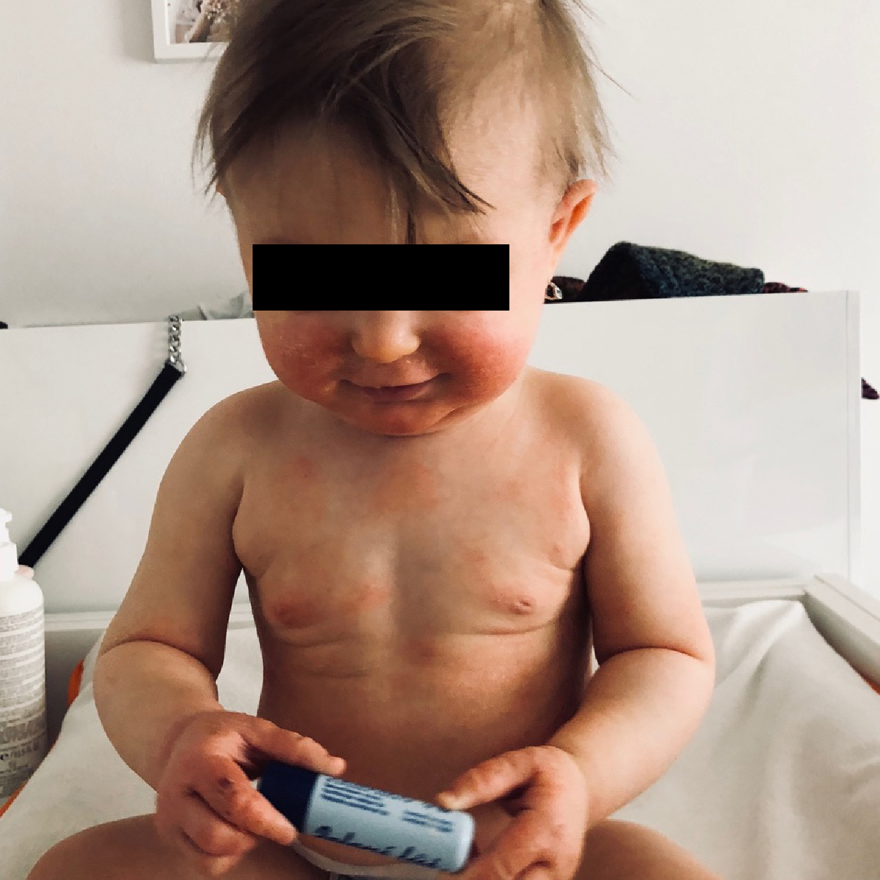 ekzém homeopatie