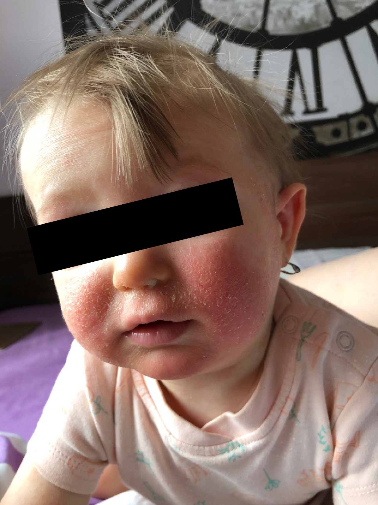 ekzém homeopatie