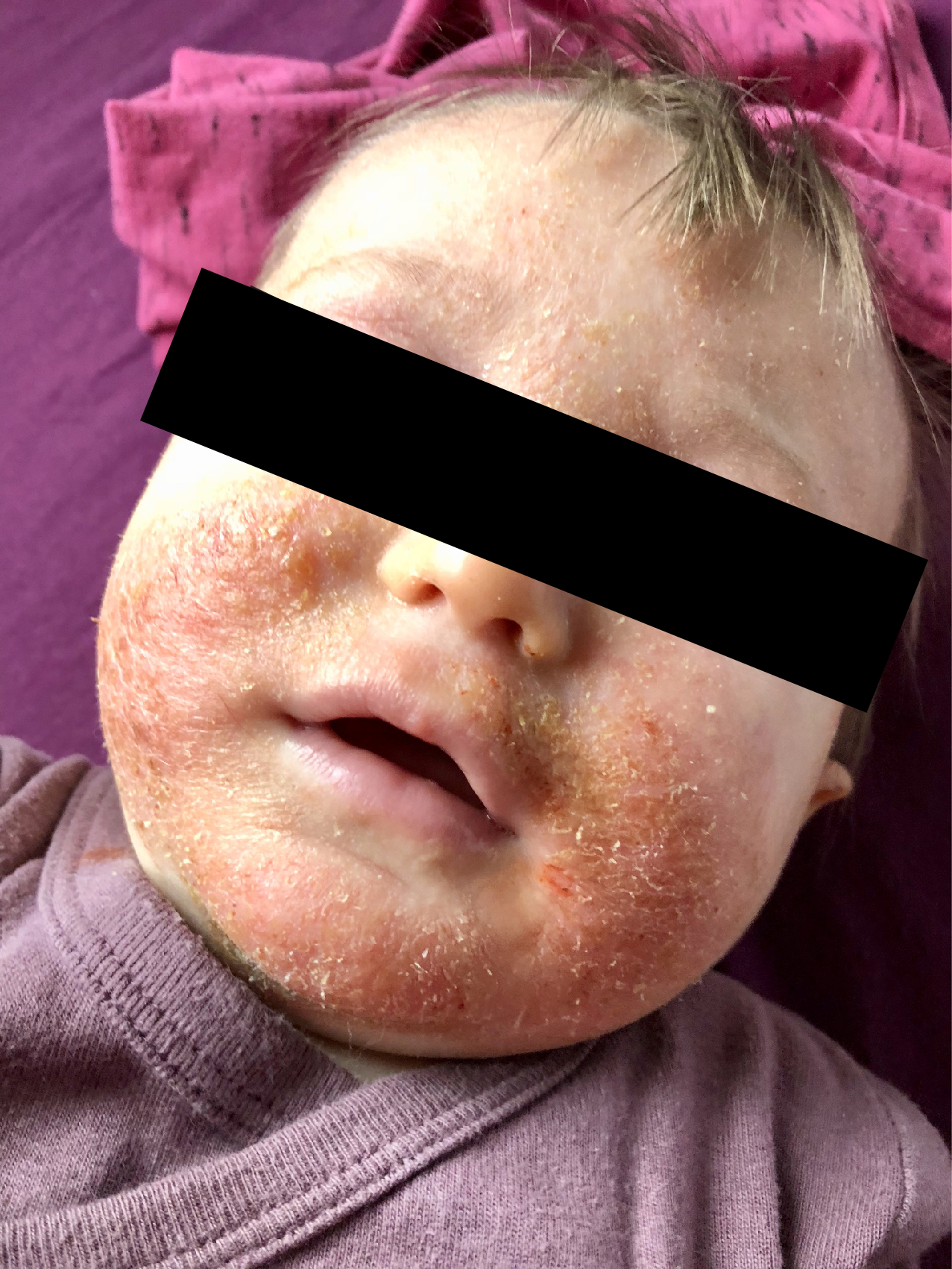 Ekzém homeopatie