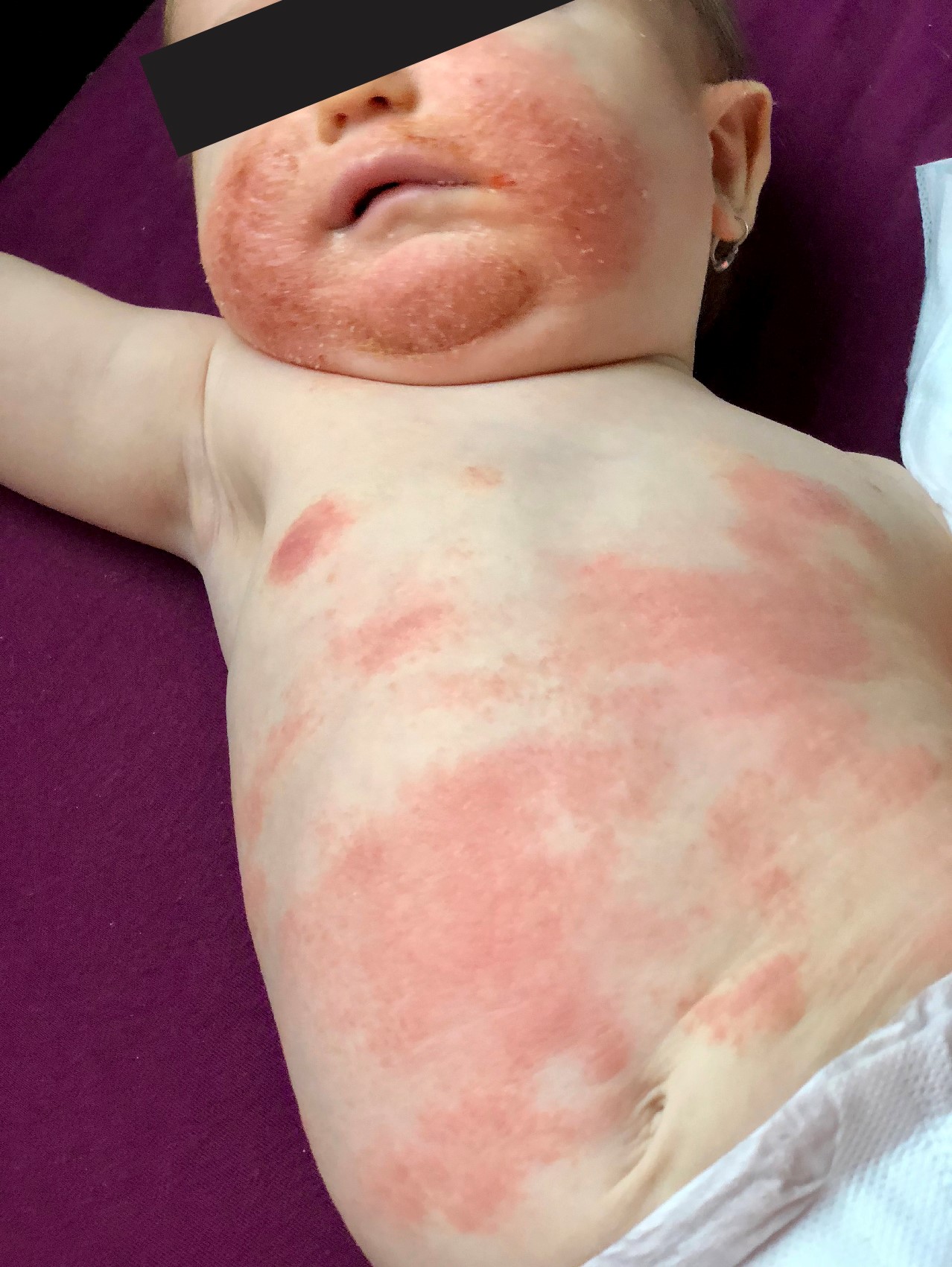 ekzém homeopatie